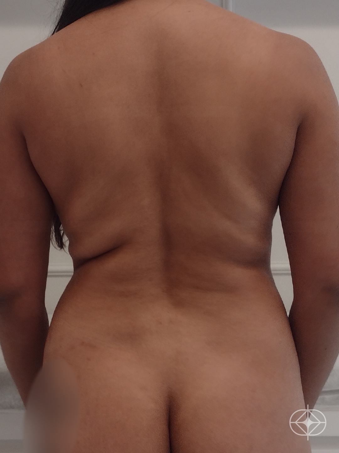 Lipoaspiração / Lipo HD - Pré