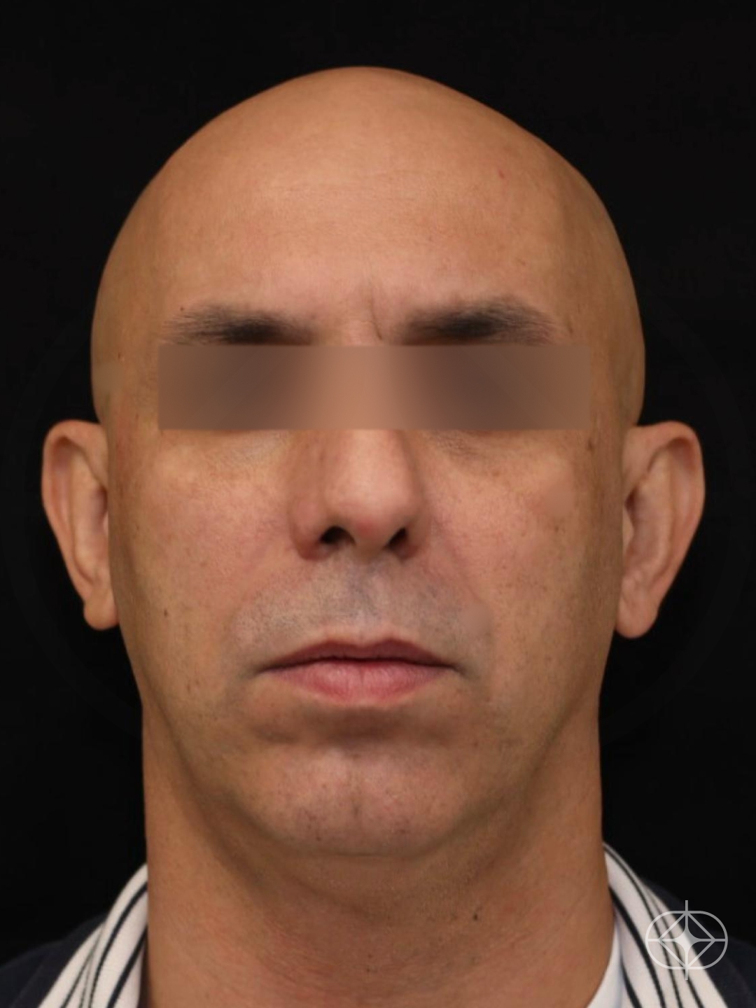 Foto antes de Otoplastia (orelhas) realizado por Dr. Eduardo Zomer