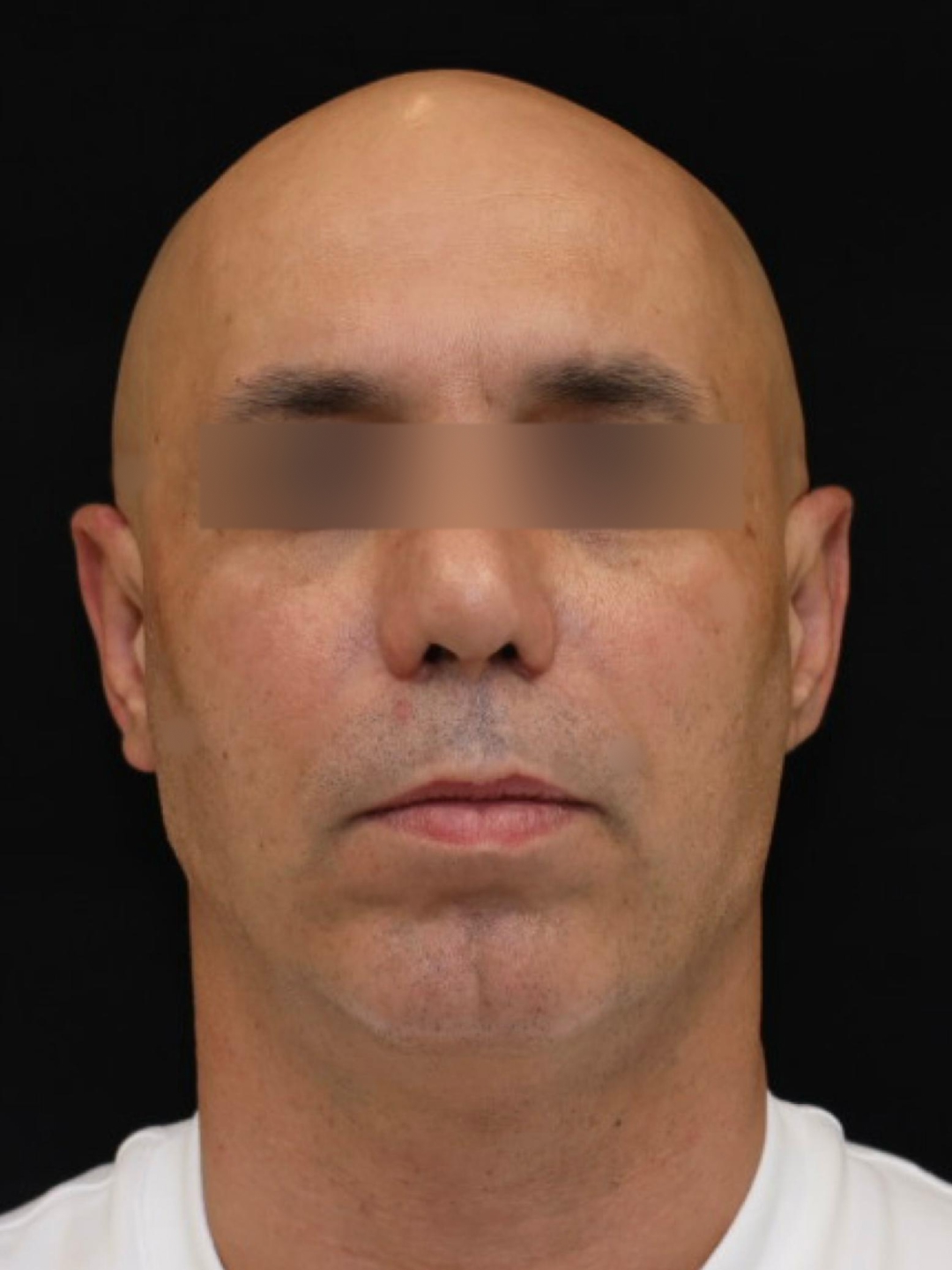 Resultado após Otoplastia (orelhas) realizado por Dr. Eduardo Zomer