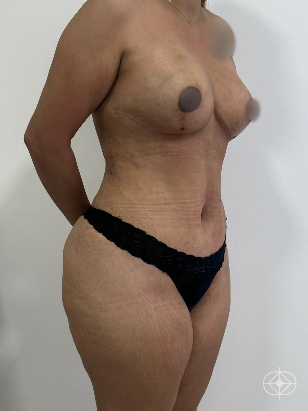 Resultado após Abdominoplastia realizado por Dr. João Ferreira