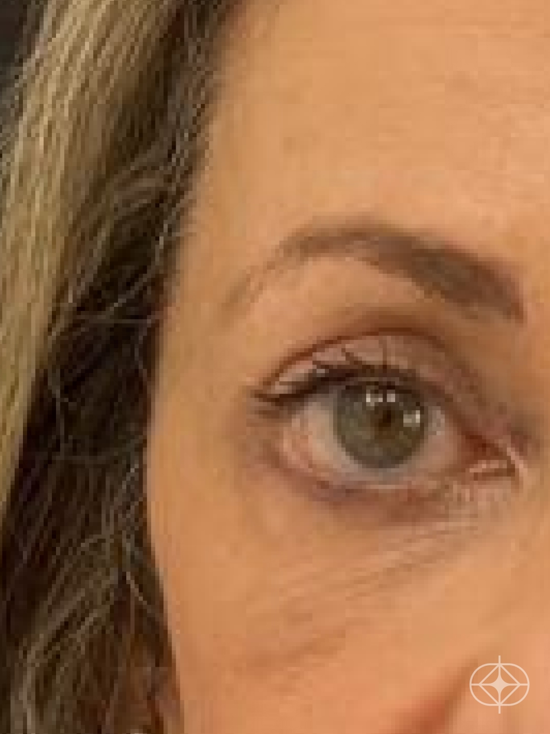 Blefaroplastia (olhos) - Pós