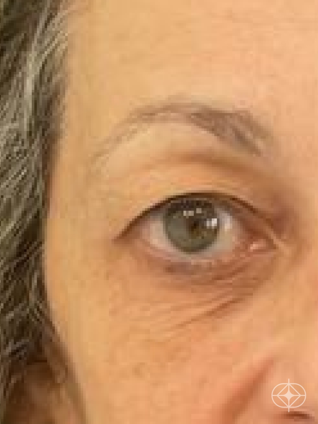 Blefaroplastia (olhos) - Pré