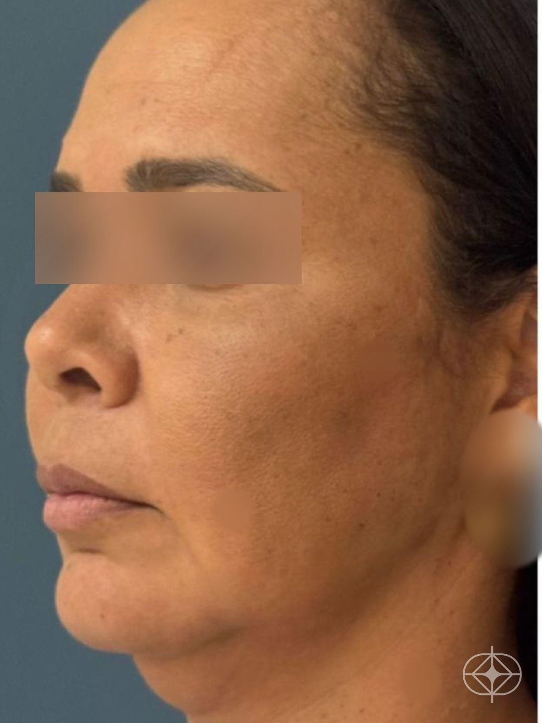 Facelift (Lifting Facial) - Pré