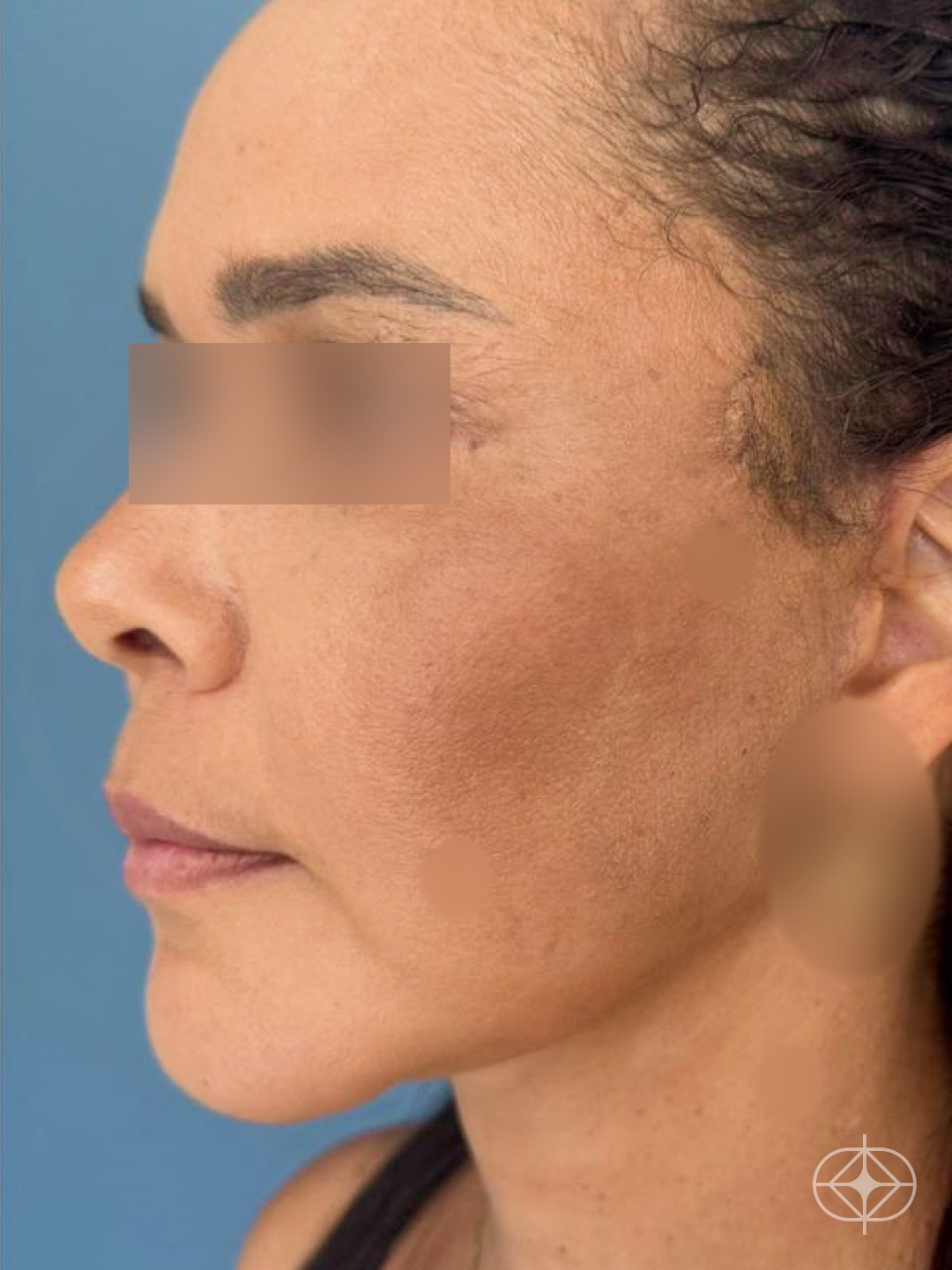 Facelift (Lifting Facial) - Pós