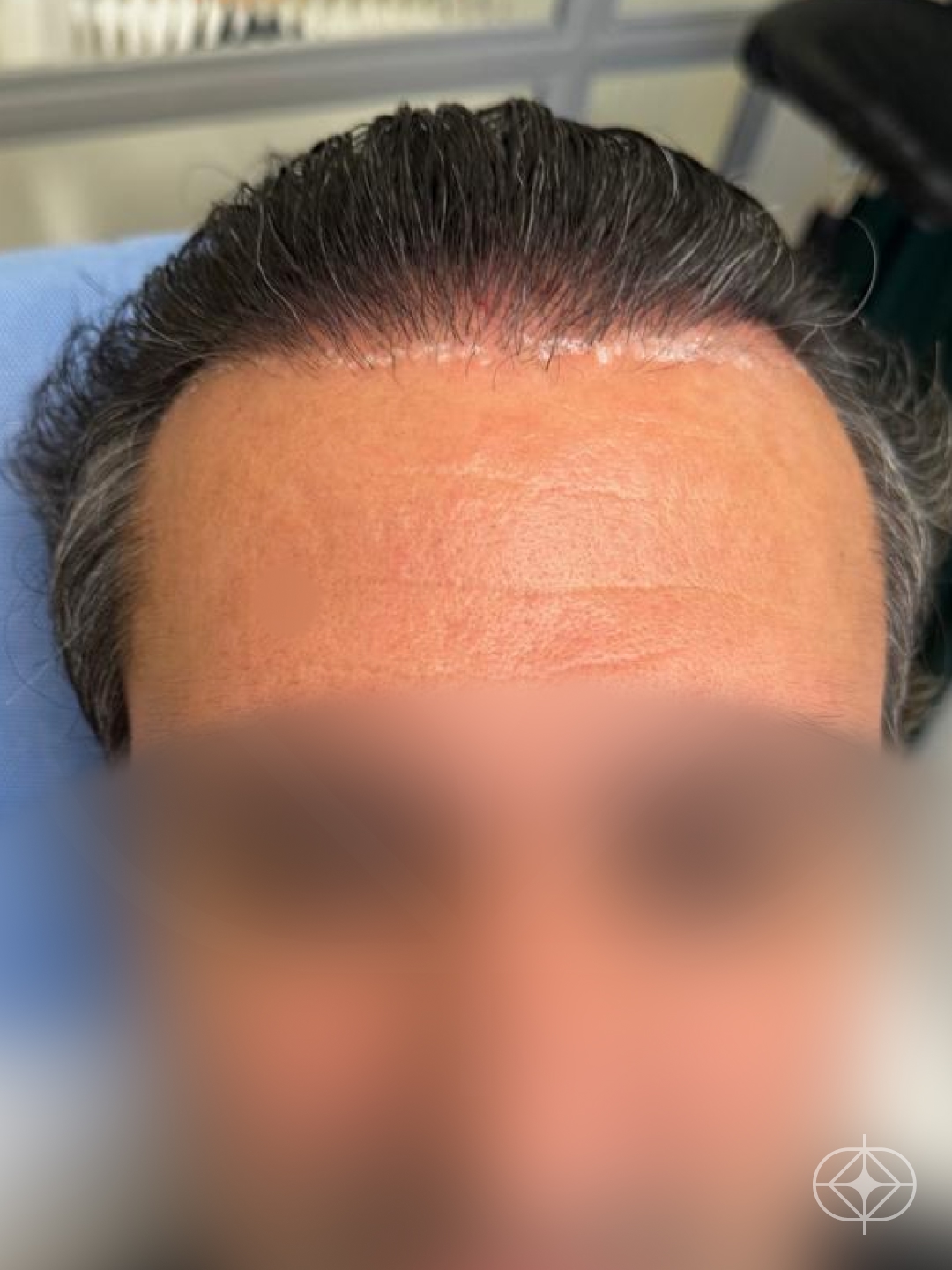 Resultado após Transplante Capilar (cabelo) realizado por Dra. Fernanda Vicente