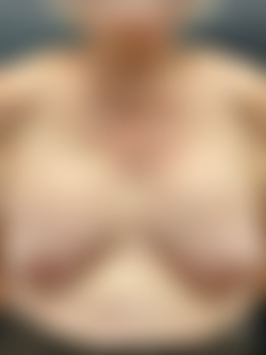 Foto antes de Explante / Remoção de Silicone realizado por Dr. Henrique Riggenbach Muller