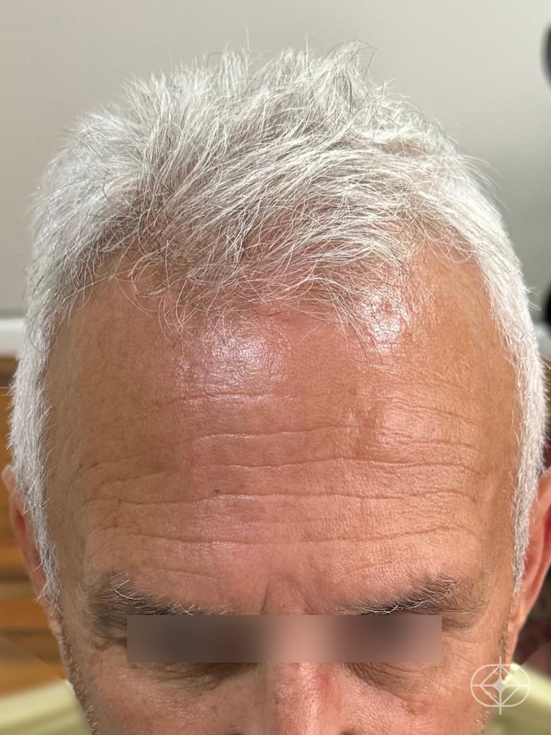Foto antes de Transplante Capilar (cabelo) realizado por Dr. Mohamed Najmeddine