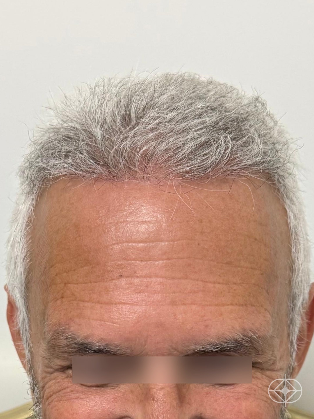 Resultado após Transplante Capilar (cabelo) realizado por Dr. Mohamed Najmeddine