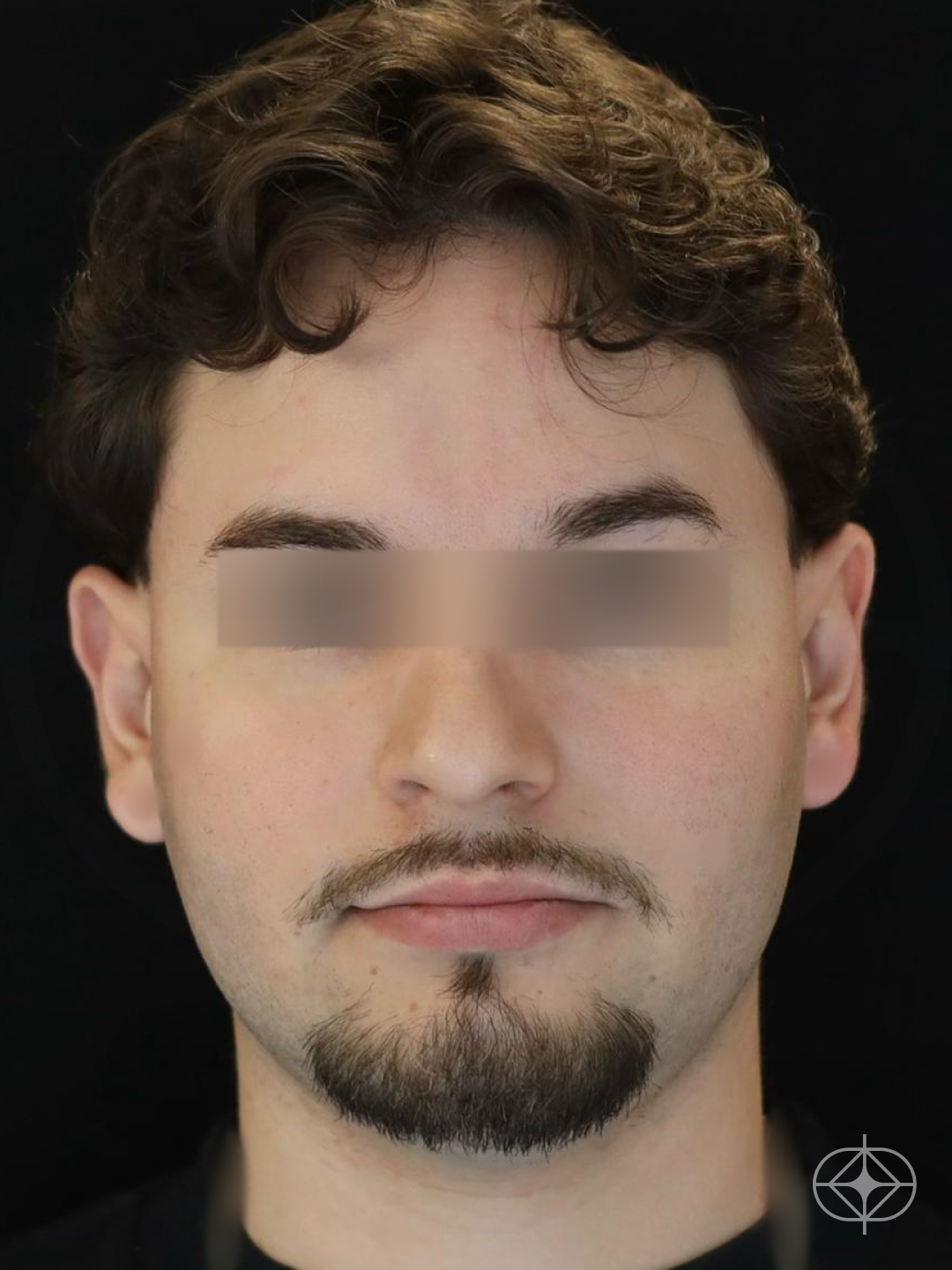 Foto antes de Otoplastia (orelhas) realizado por Dr. Eduardo Zomer