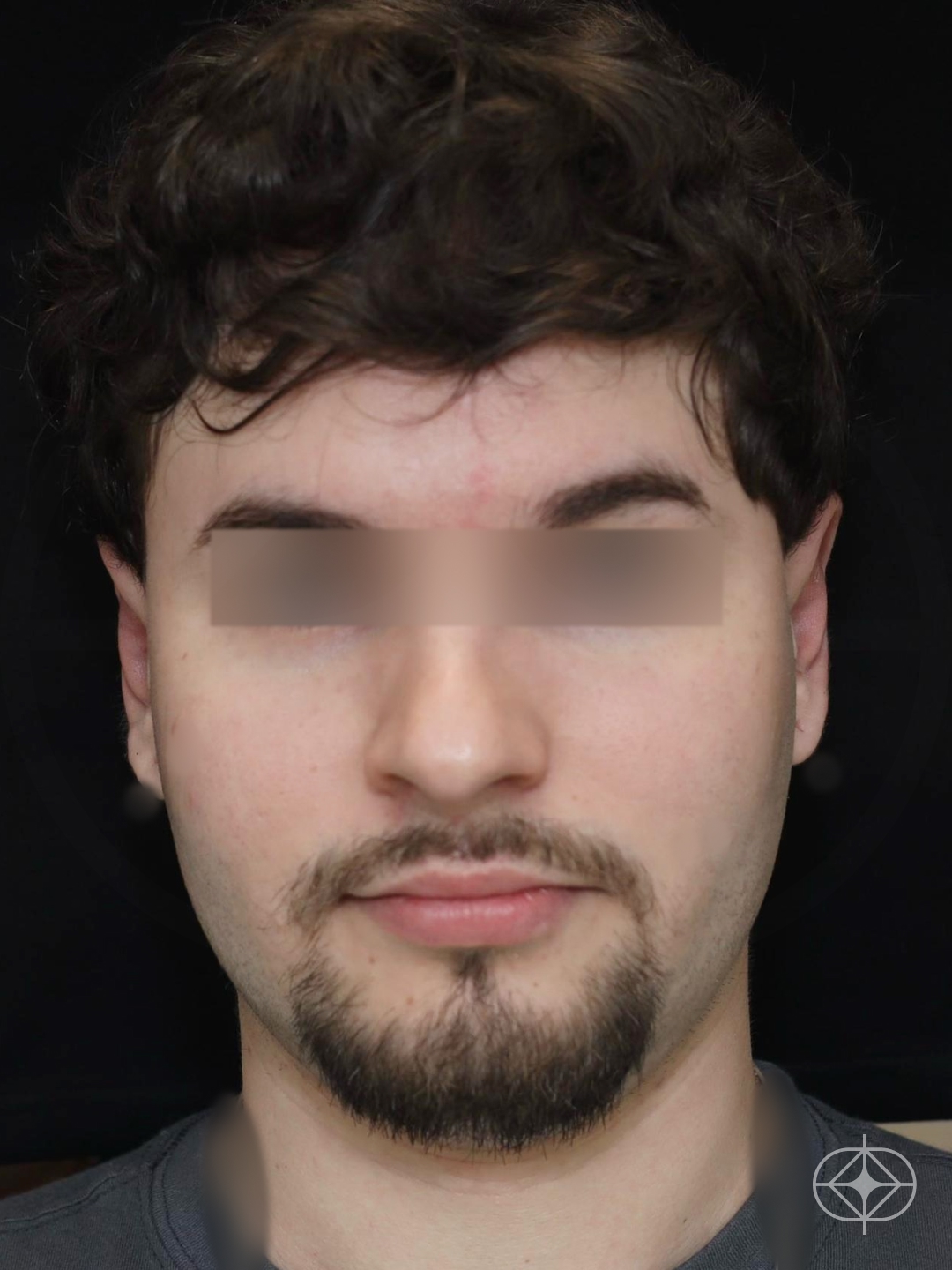 Resultado após Otoplastia (orelhas) realizado por Dr. Eduardo Zomer