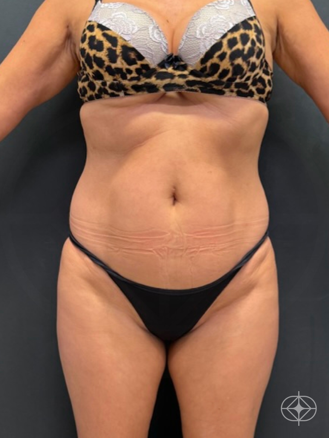 Foto antes de Abdominoplastia realizado por Dr. Felipe de David