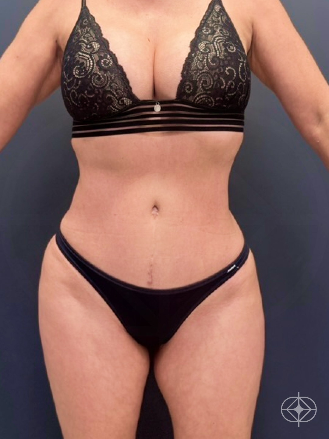Resultado após Abdominoplastia realizado por Dr. Felipe de David