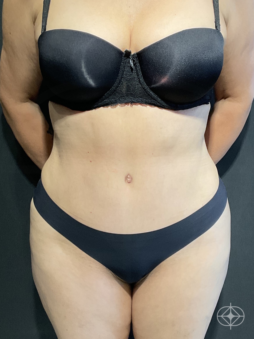 Resultado após Lipoaspiração / Lipo HD realizado por Dr. Thiago Tubone