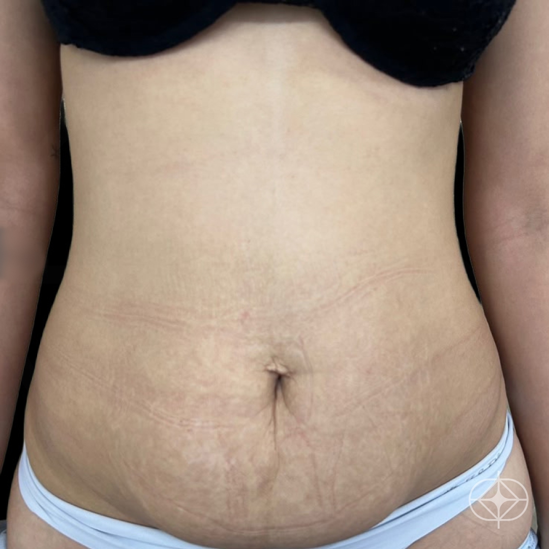 Foto antes de Abdominoplastia realizado por Dr. Renato Saliba Donatelli