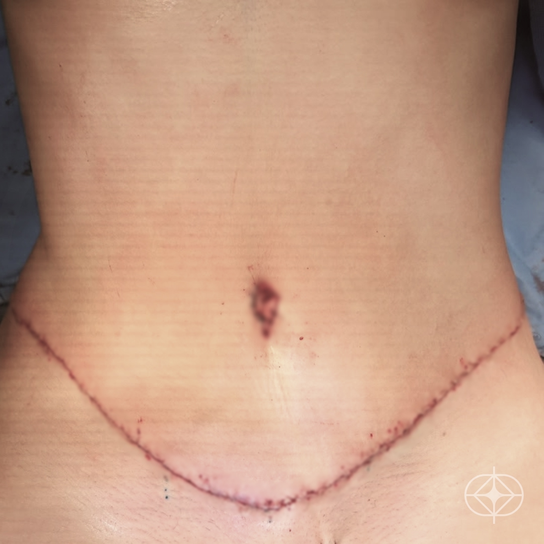 Resultado após Abdominoplastia realizado por Dr. Renato Saliba Donatelli