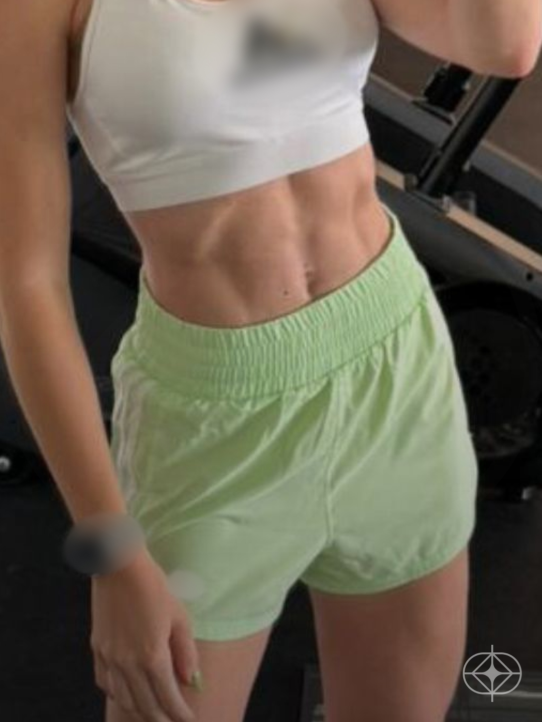 Resultado após Lipoaspiração / Lipo HD realizado por Dr. Luis Fernando Bacarin