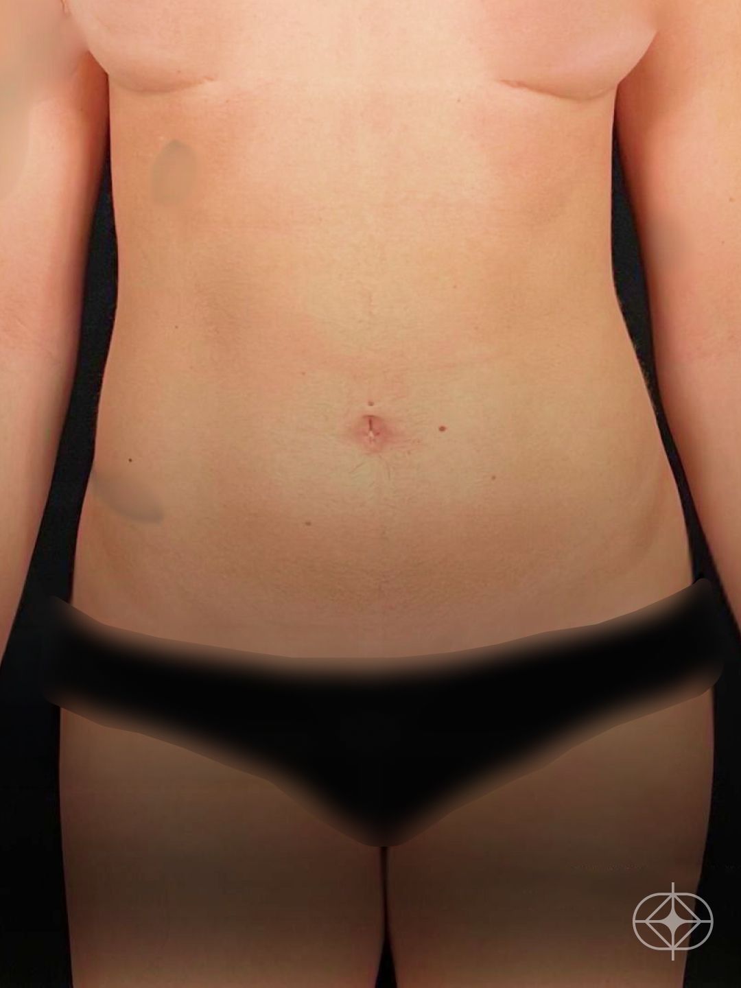 Foto antes de Lipoaspiração / Lipo HD realizado por Dr. Luis Fernando Bacarin