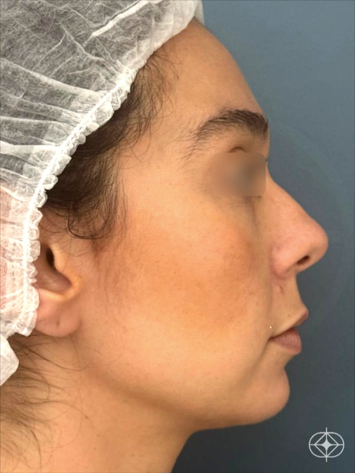 Rinoplastia (nariz) - Pré