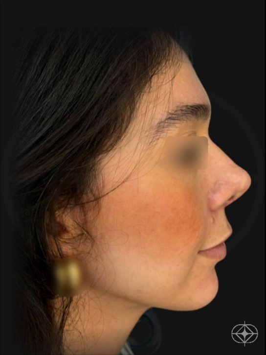 Rinoplastia (nariz) - Pós