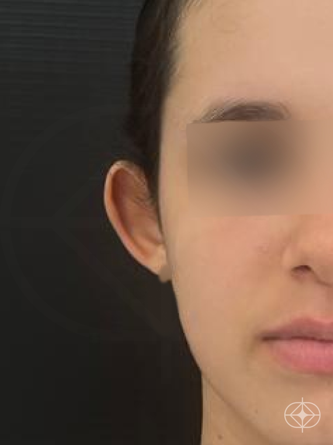 Otoplastia (orelhas) - Pré