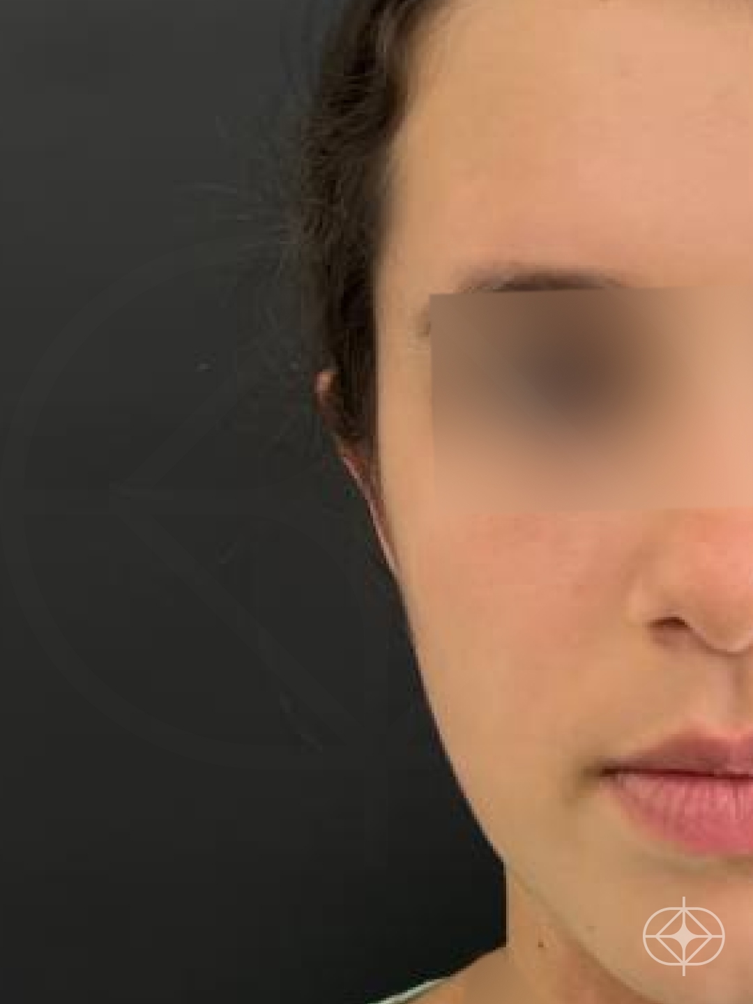 Otoplastia (orelhas) - Pós