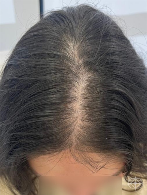 Foto antes de Capilar (alopecia, dermatite, psoríase) realizado por Dra. Angélica Seidel