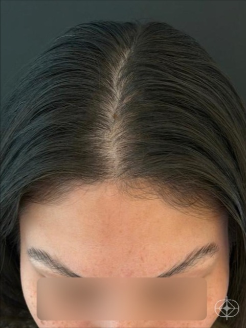 Resultado após Capilar (alopecia, dermatite, psoríase) realizado por Dra. Angélica Seidel