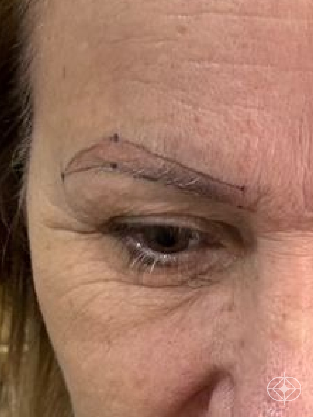 Foto antes de Transplante de Sobrancelhas realizado por Dr. Mohamed Najmeddine