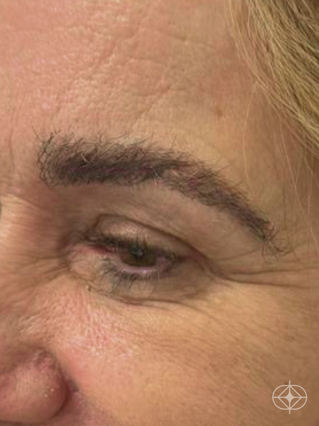 Resultado após Transplante de Sobrancelhas realizado por Dr. Mohamed Najmeddine