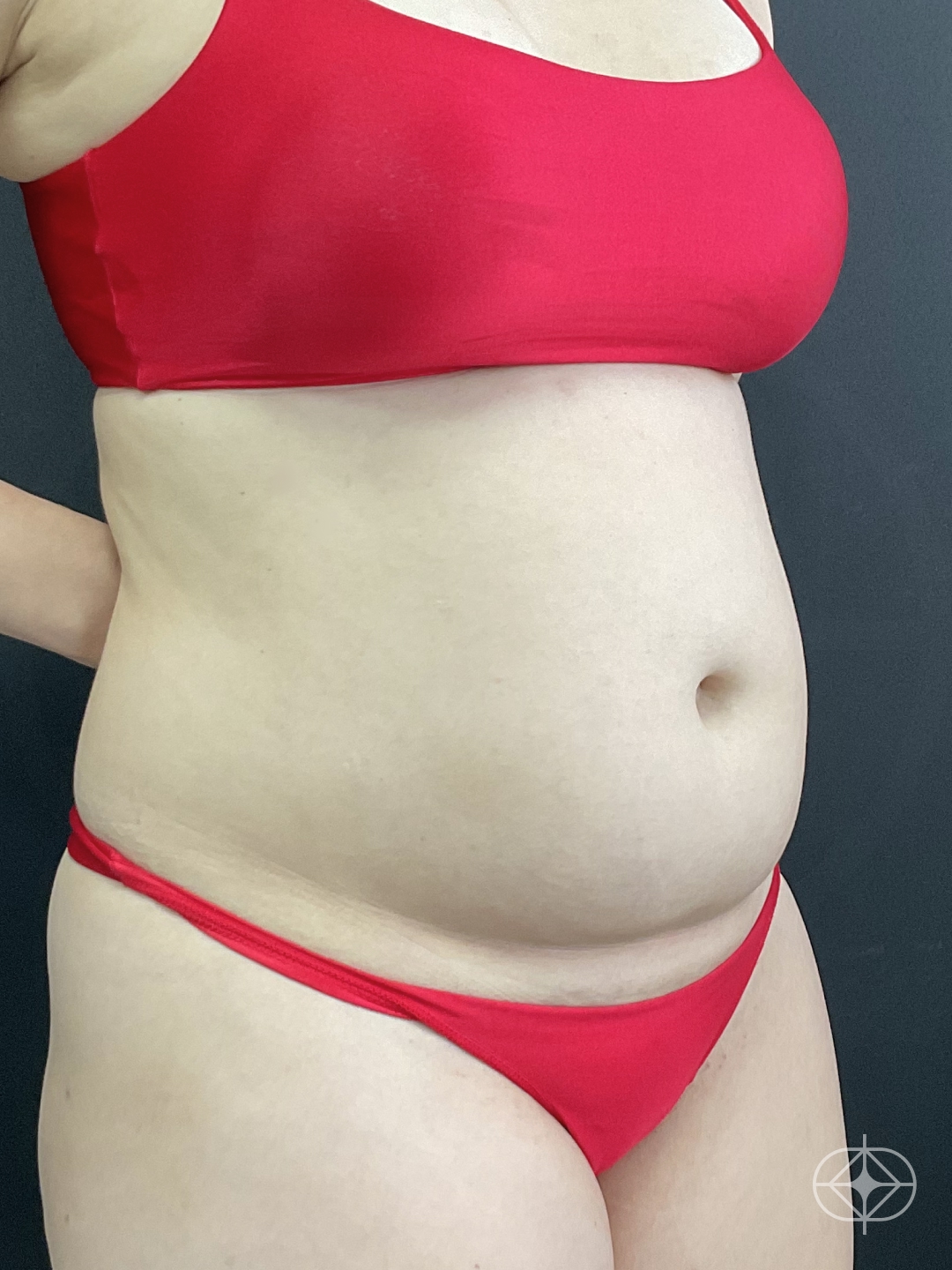 Foto antes de Lipoaspiração / Lipo HD realizado por Dr. Thiago Tubone