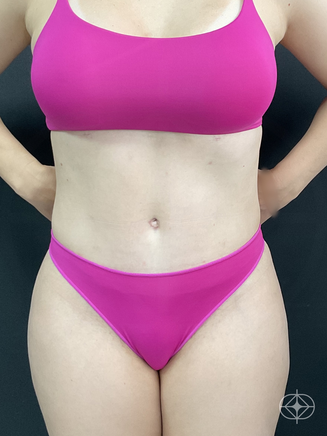Resultado após Lipoaspiração / Lipo HD realizado por Dr. Thiago Tubone