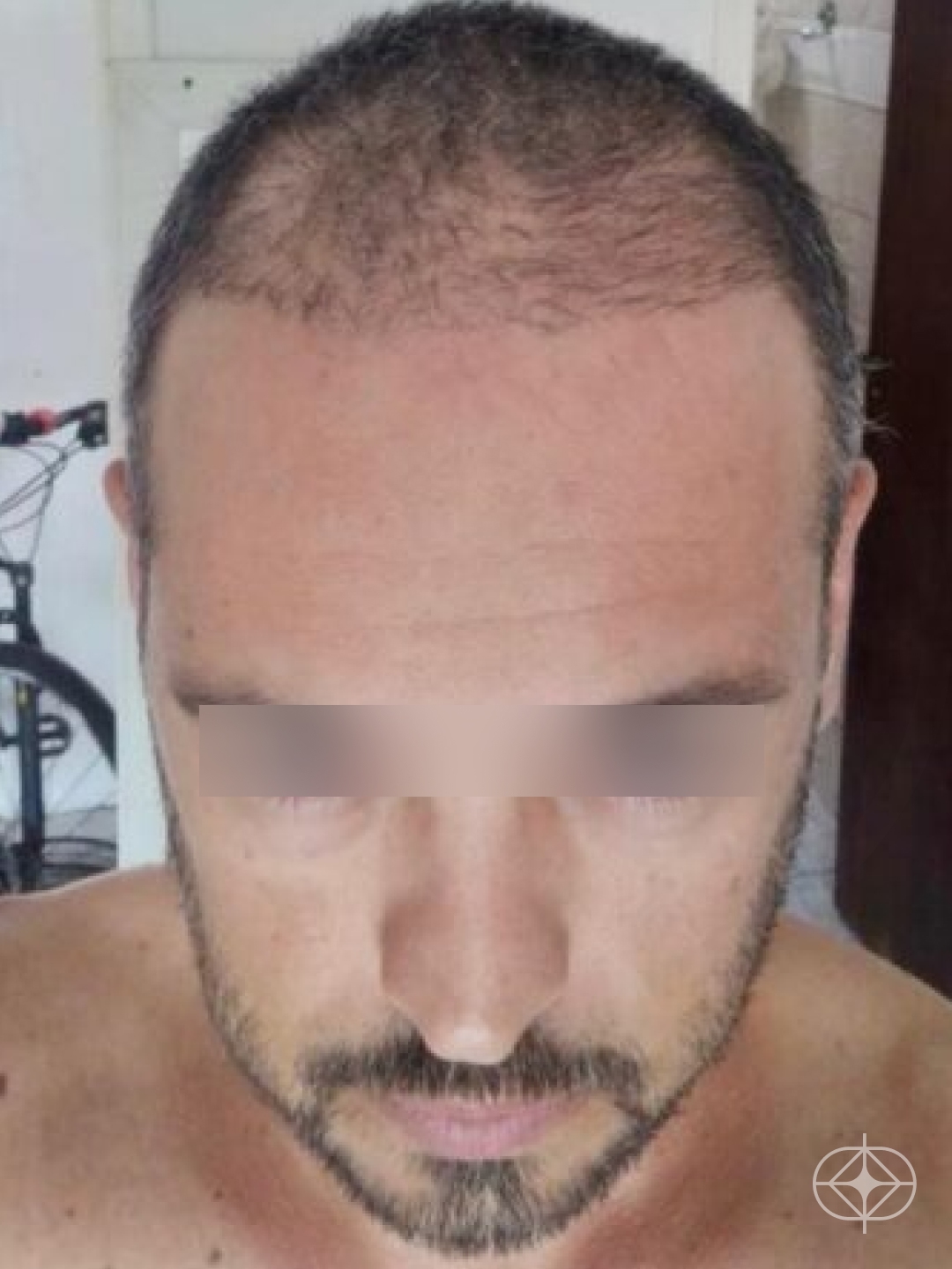 Transplante Capilar - Pré