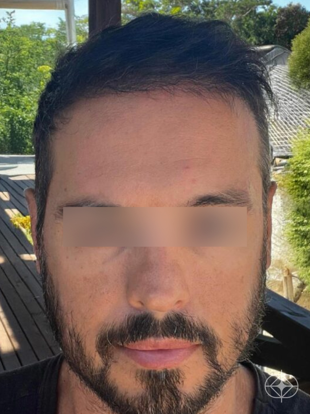 Transplante Capilar - Pós