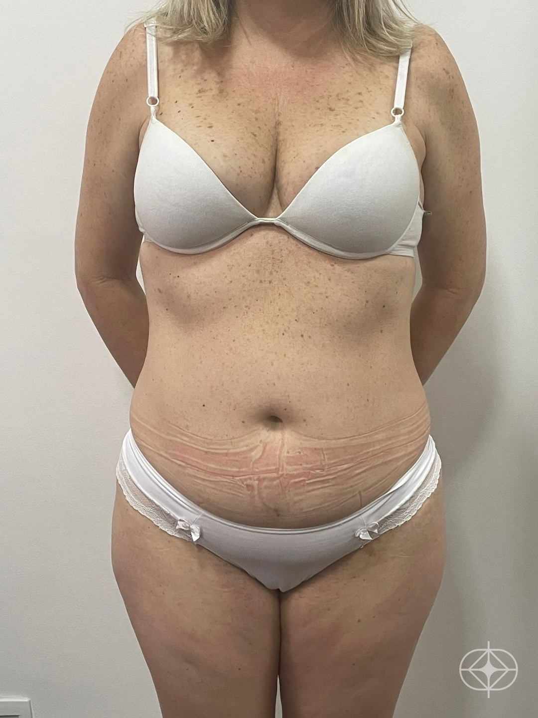 Foto antes de Abdominoplastia realizado por Dr. João Ferreira