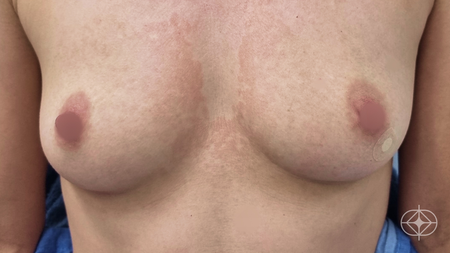 Foto antes de Reconstrução Mamária (mastectomia) realizado por Dr. Adriano Oliveira