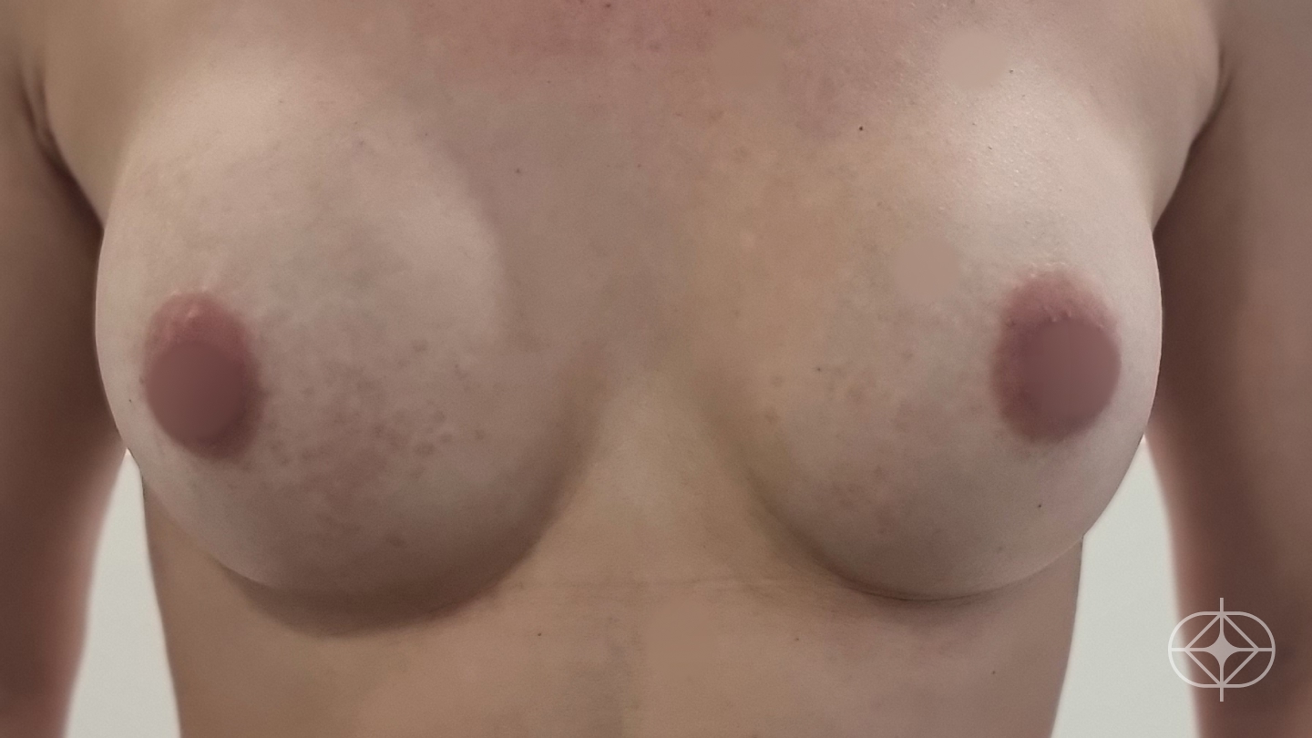 Resultado após Reconstrução Mamária (mastectomia) realizado por Dr. Adriano Oliveira