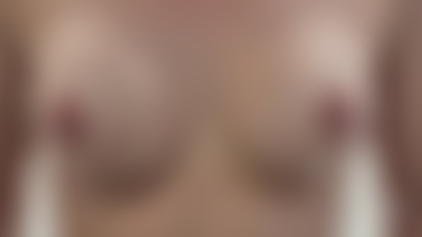 Resultado após Reconstrução Mamária (mastectomia) realizado por Dr. Adriano Oliveira