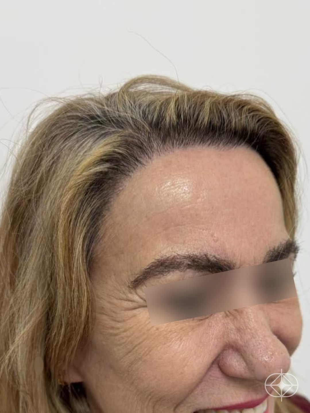 Resultado após Transplante Capilar (cabelo) realizado por Dr. Mohamed Najmeddine