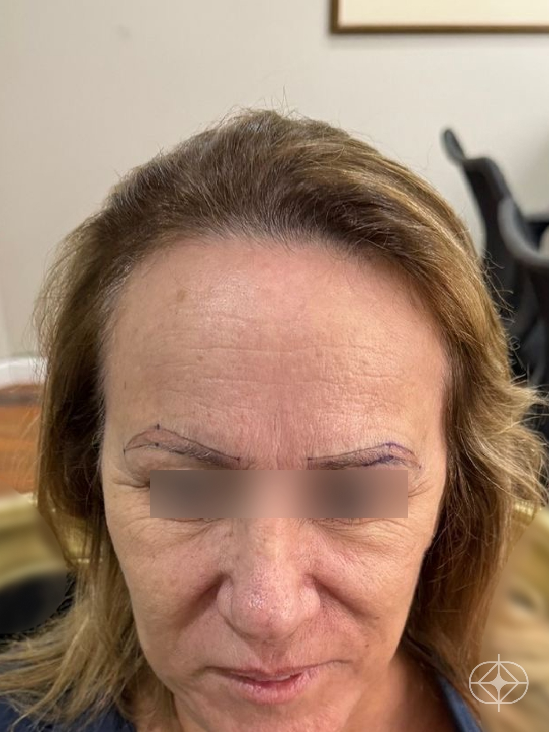 Foto antes de Transplante Capilar (cabelo) realizado por Dr. Mohamed Najmeddine