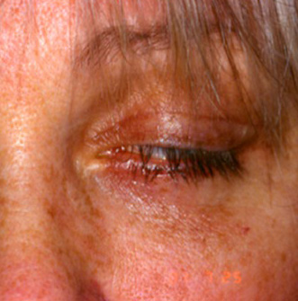Resultado insatisfatório de Blefaroplastia (olhos)