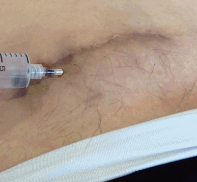 Resultado insatisfatório de Abdominoplastia