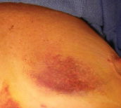 Resultado insatisfatório de Mamoplastia Redutora