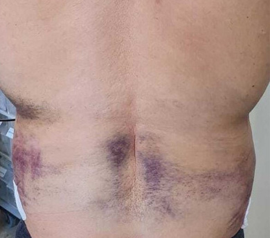 Resultado insatisfatório de Lipoaspiração / Lipo HD