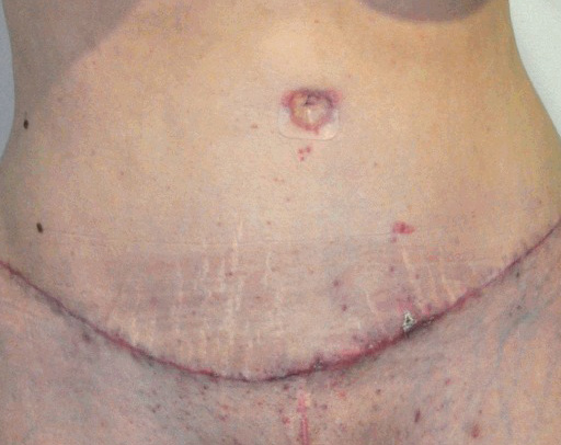 Resultado insatisfatório de Abdominoplastia