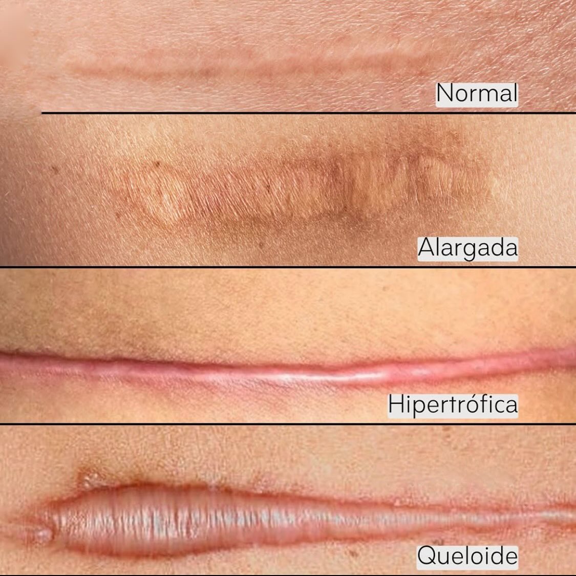 Resultado insatisfatório de Prótese Mama / R24R (silicone)