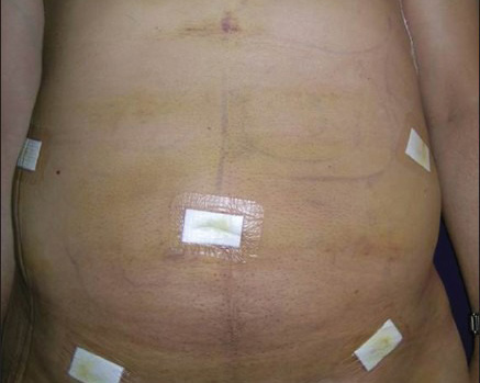 Resultado insatisfatório de Lipoaspiração / Lipo HD