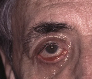 Resultado insatisfatório de Blefaroplastia (olhos)