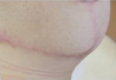 Resultado insatisfatório de Mamoplastia Redutora