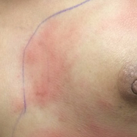 Resultado insatisfatório de Explante / Remoção de Silicone