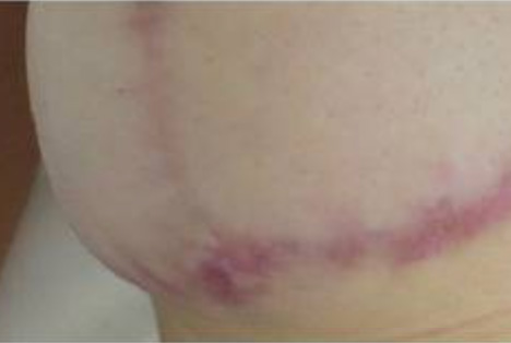 Resultado insatisfatório de Mamoplastia Redutora